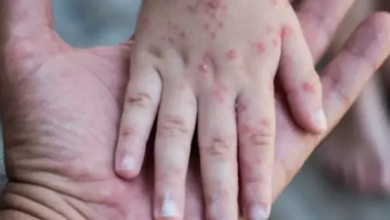 وفاة 11 طفلاً بالحصبة في أوغندا: تفاصيل تفشي الوباء في ناباك