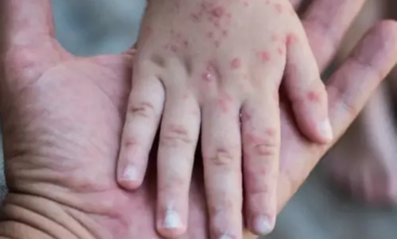 وفاة 11 طفلاً بالحصبة في أوغندا: تفاصيل تفشي الوباء في ناباك