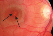 مخاطر أجهزة الليزر على العين: تحذير من فقدان البصر الدائم