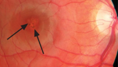 مخاطر أجهزة الليزر على العين: تحذير من فقدان البصر الدائم