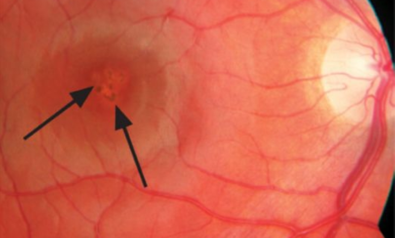 مخاطر أجهزة الليزر على العين: تحذير من فقدان البصر الدائم
