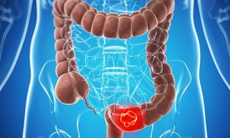 بكتيريا الإي كولاي وسرطان القولون: دراسة تكشف الرابط الخطير
