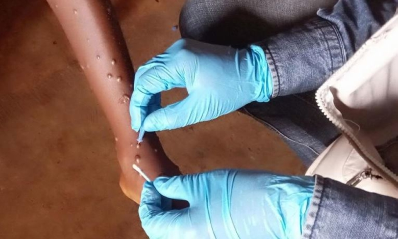 الصحة العالمية تحذر: تفشي جدري القرود وتمركز الإصابات بإفريقيا