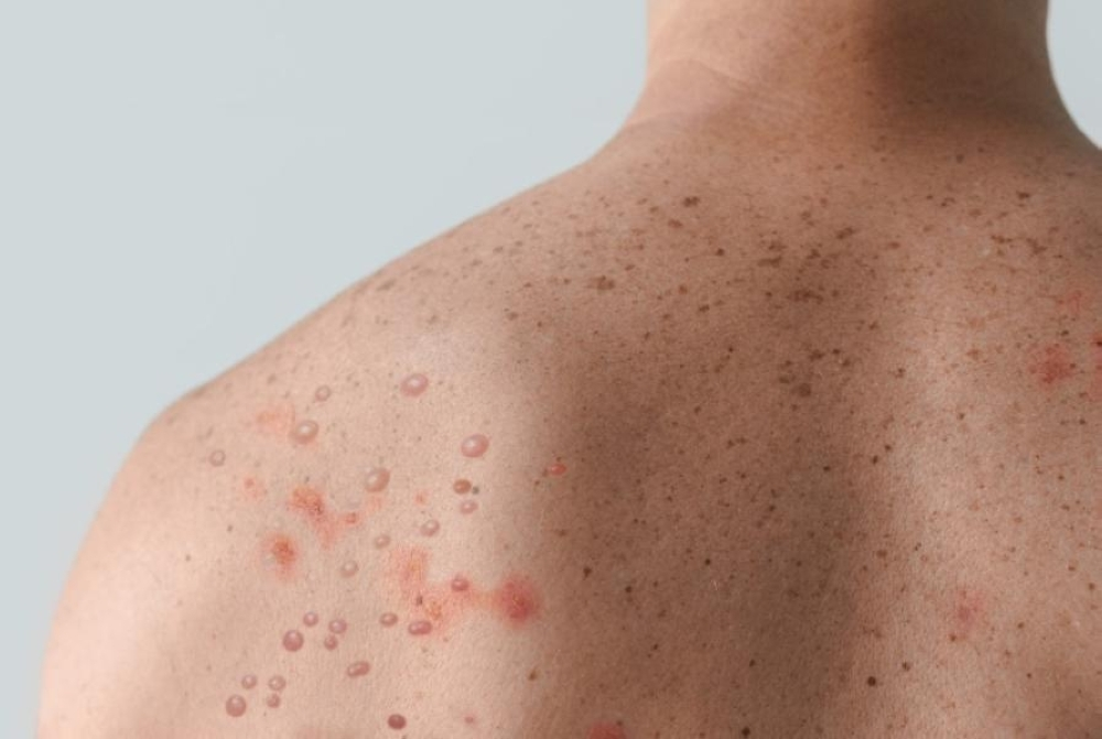 انتشار جدري القرود عالميًا