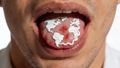 اللسان الجغرافي: الأسباب والأعراض وطرق العلاج والوقاية