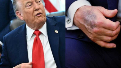 ترامب يكشف سر كدمات يده ويتباهى باختبار القدرات الذهنية