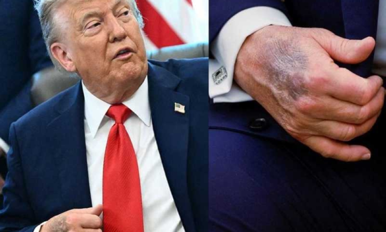 ترامب يكشف سر كدمات يده ويتباهى باختبار القدرات الذهنية