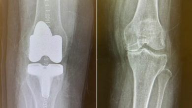 مستشفى الدرعية: برنامج تأهيلي يعيد الحركة لمريض بعد زراعة المفصل