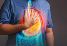 أحدث طرق علاج ارتجاع المريء 2024: الأدوية والجراحة