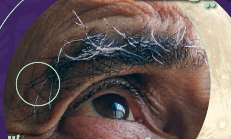 قافلة طبية لدعم 1820 أسرة لمرضى ألزهايمر في السعودية